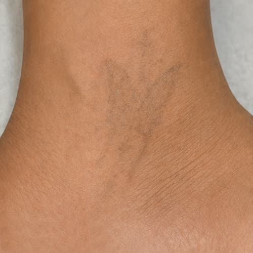 After - Butterfly tattoo removal