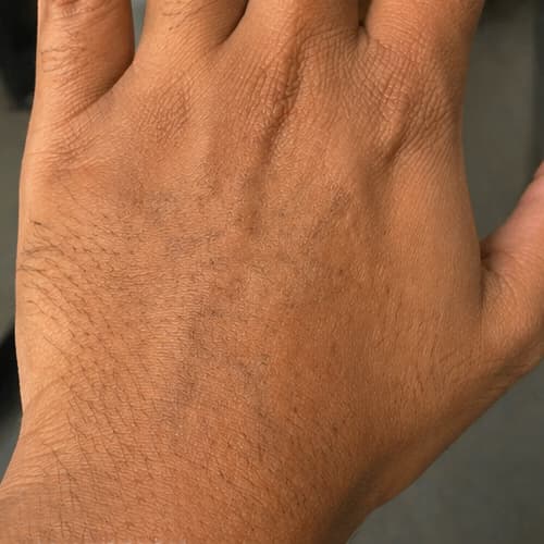 After - Crown K tattoo removal
