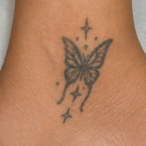 Before - Butterfly tattoo removal