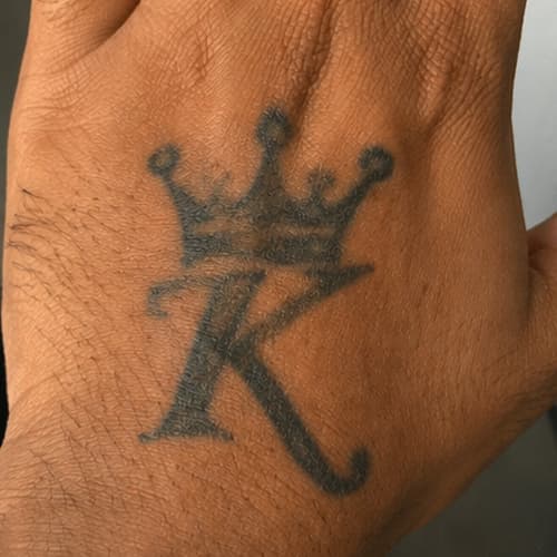 Before - Crown K tattoo removal